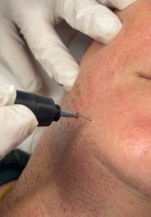 plasma fibroblast for neck and skin tightening