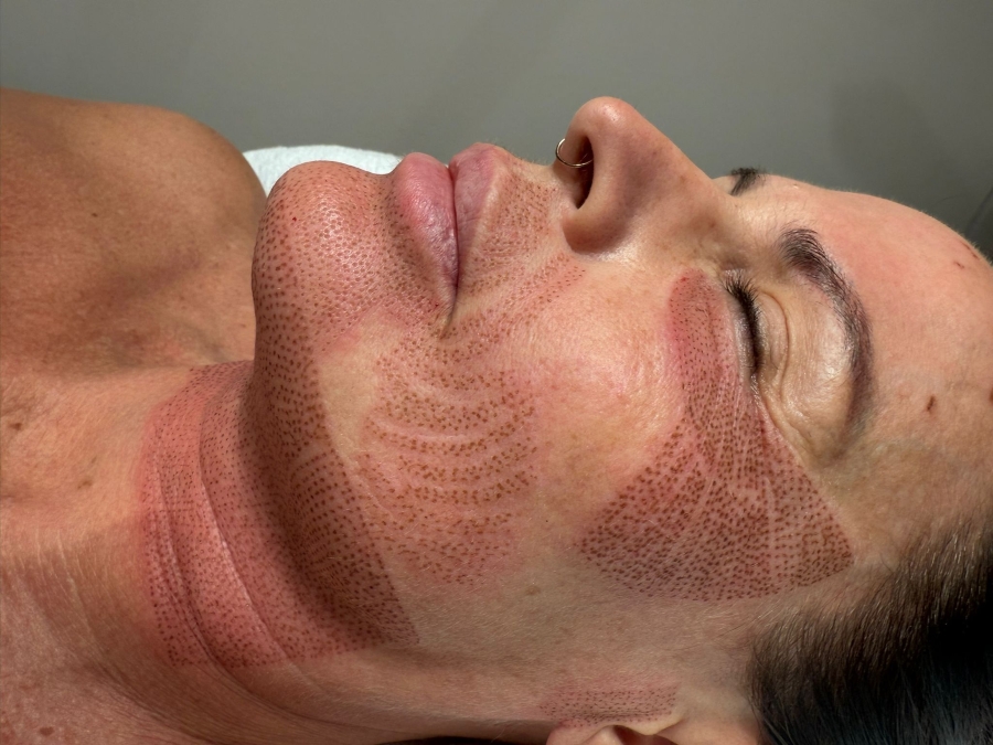 plasma fibroblast jowls North Skin Mona Vale