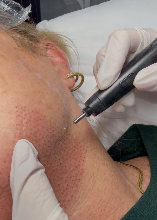plasma fibroblast jowls North Skin Mona Vale