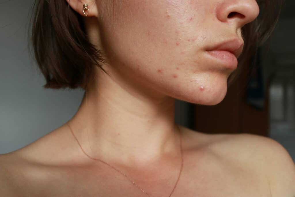 image of young woman with adult acne on her lower face and chin