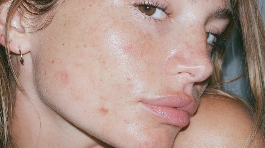 damaged skin barrier