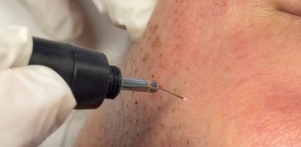 plasma fibroblast for neck and skin tightening