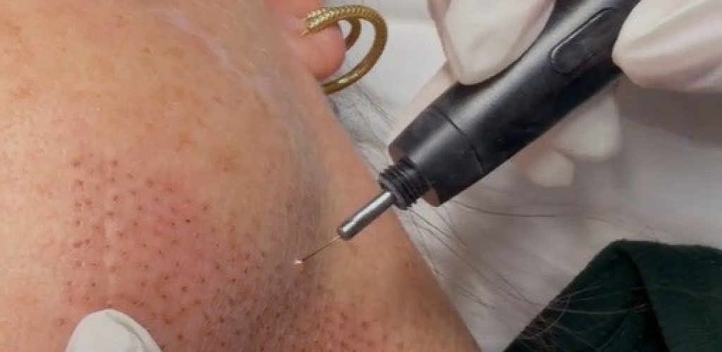 plasma fibroblast jowls North Skin Mona Vale
