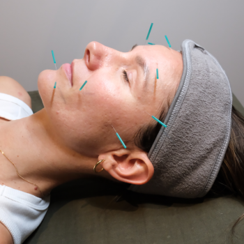 cosmetic acupuncture