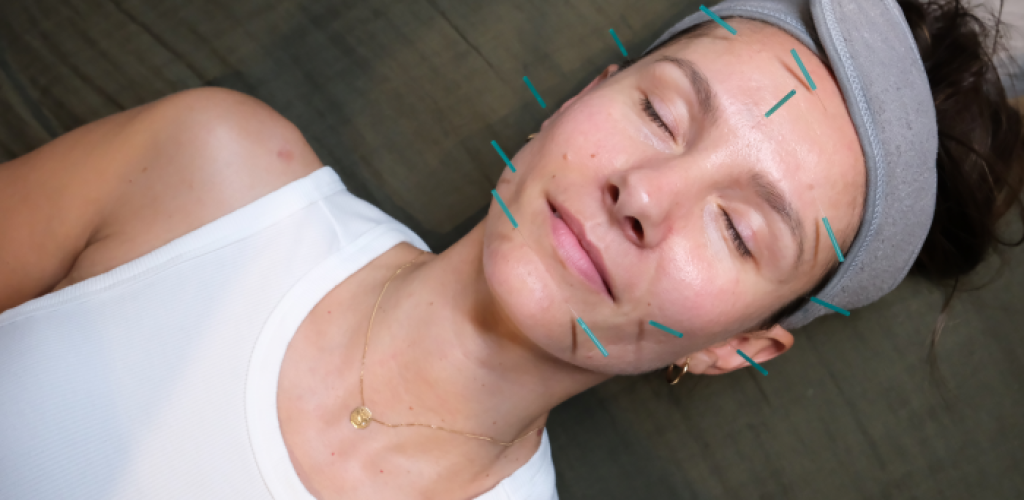 cosmetic acupuncture Northern Beaches North Skin Mona Vale