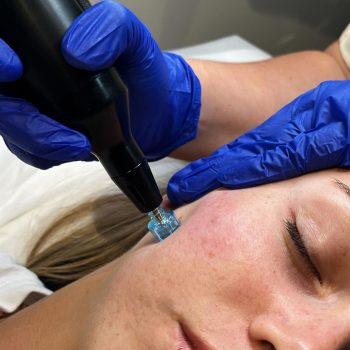 fusion8 plasma infusion stamp treatment