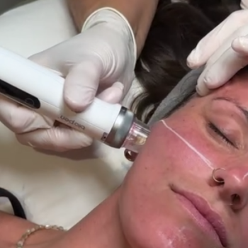 Skin Needling
