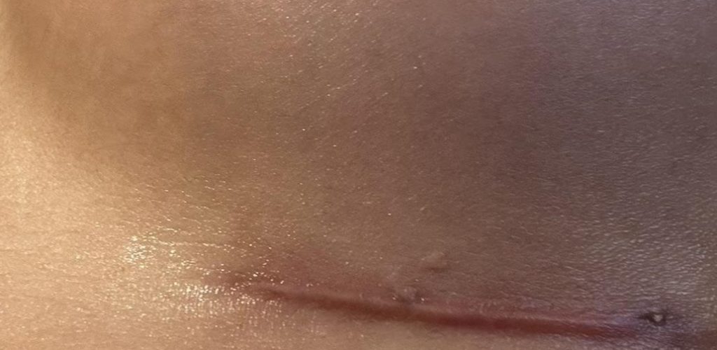 breast-augmentation-scar-red-and-raised-v0-wgdcs3br33sf1