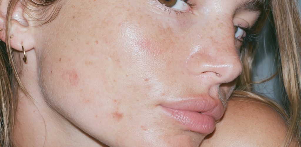 damaged skin barrier