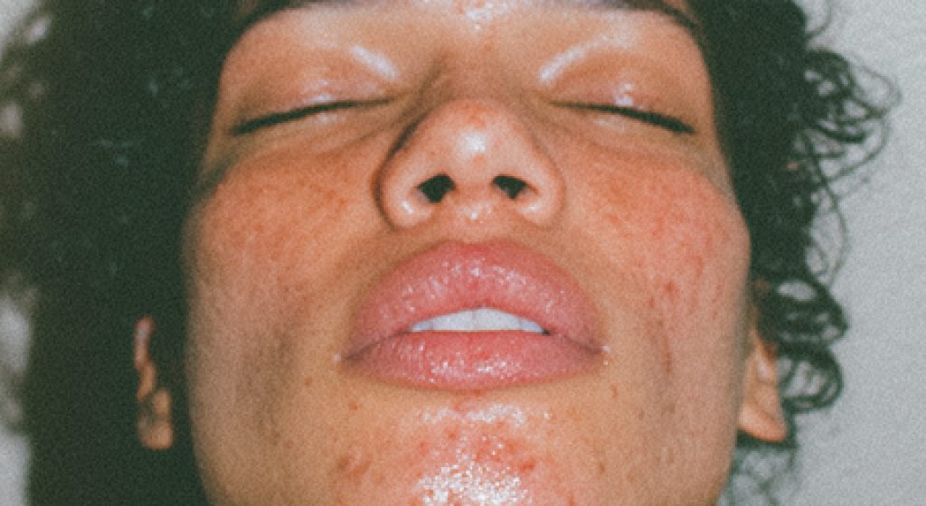 mi_1603_13826_perioral_dermatitis_around_the_mouth_-chaos_30_998d37a5-4a96-40f7-bcea-d413c9172ace_1-771x1024 1