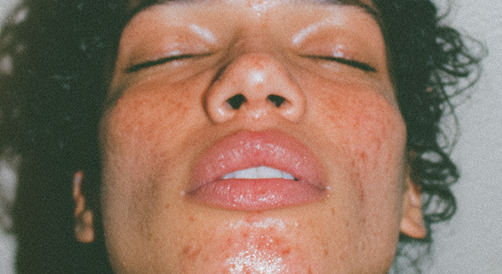 mi_1603_13826_perioral_dermatitis_around_the_mouth_--chaos_30_998d37a5-4a96-40f7-bcea-d413c9172ace_1