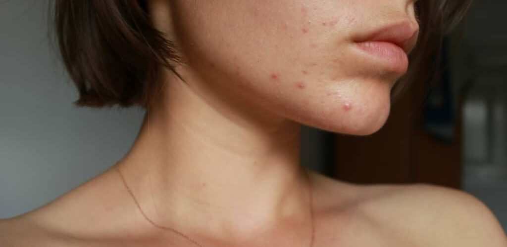 image of young woman with adult acne on her lower face and chin
