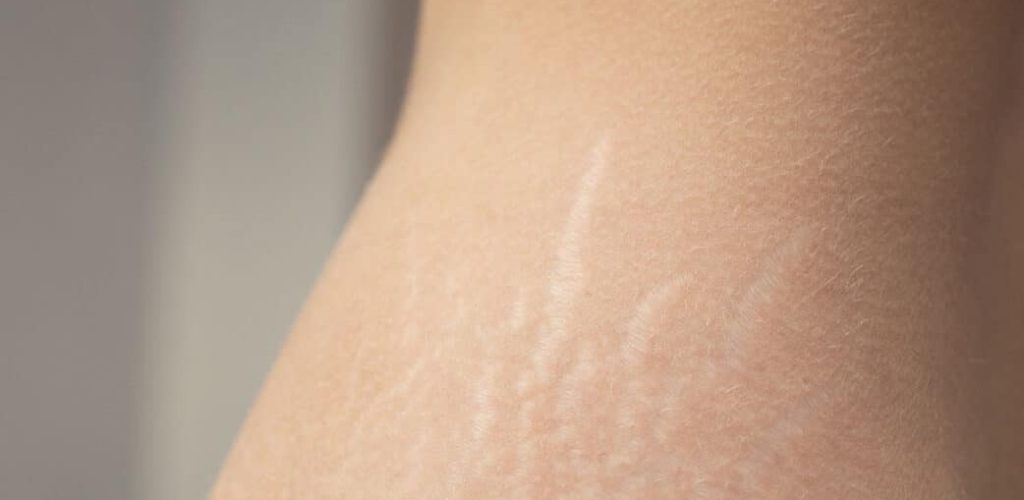 stretch-marks